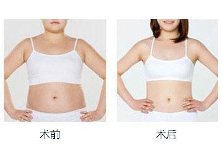 360度環(huán)形吸脂有哪些術(shù)后注意事項？