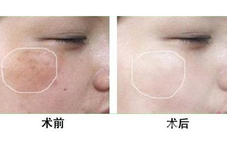 *風(fēng)范祛斑多少錢一次 與哪些因素有關(guān)？