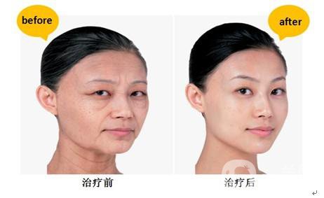 *生物除皺*果怎么樣？能持續(xù)多久？