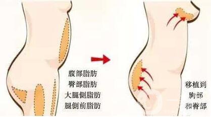 上海,自體脂肪豐臀,價(jià)格