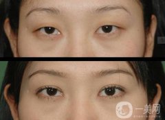 北京哪家醫(yī)院割雙眼皮果好？