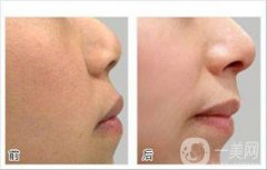 光子嫩膚前后*果嗎 果怎么樣？