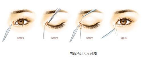 做開內(nèi)外眼角手術需要多少錢？