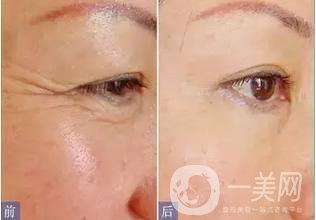 *去魚尾紋*嗎 *果怎么樣？