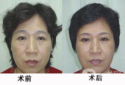 熱瑪吉除皺*果怎么樣？有哪些優(yōu)勢？