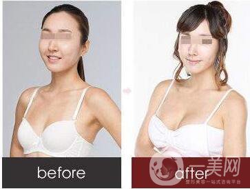 妙桃豐胸,多少錢