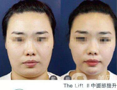 塑美極面部提升價格 塑美極面部提升要多少錢