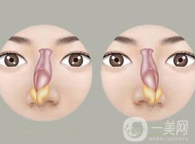 歪鼻子矯正手術(shù)多少錢(qián) 價(jià)格詳情