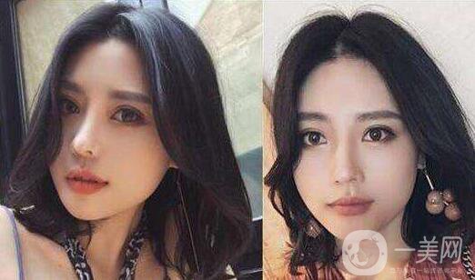 下頜角截骨手術(shù)費(fèi)用需要多少？