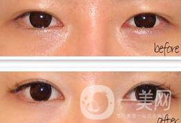 手術(shù)開(kāi)眼角要多少錢(qián) 開(kāi)眼角的費(fèi)用