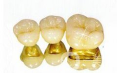 金鈀合金烤瓷牙優(yōu)缺點(diǎn)詳細(xì)介紹