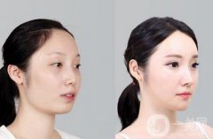 磨腮削骨多少錢？腮幫子磨骨多少錢？