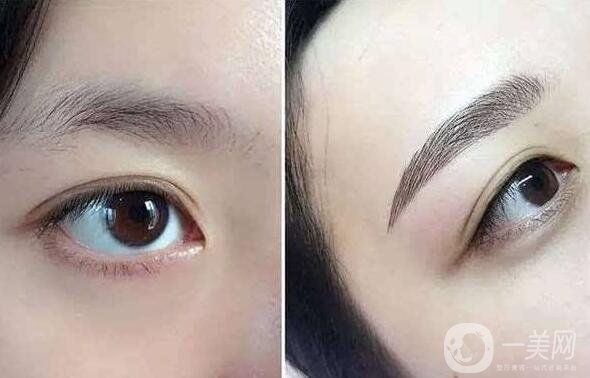 北京眉整形多少錢？價格是多少？