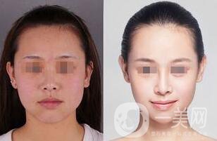 像素激光美容多少錢 像素激光美容價格詳解