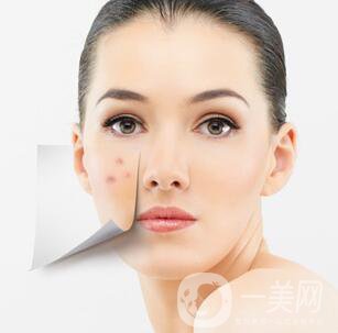 像素激光調(diào)節(jié)痘坑*果怎么樣？