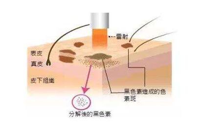 像素激光祛斑,價(jià)格