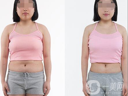 超聲波抽脂價(jià)格多少？超聲波抽脂有什么優(yōu)點(diǎn)？