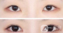 開(kāi)眼角手術(shù)醫(yī)院介紹？開(kāi)眼角哪好？