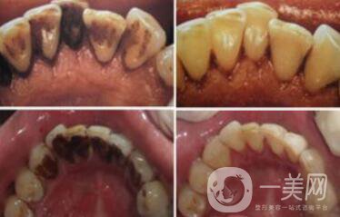 *潔牙好不好？*果可以維持幾年？