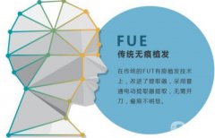 什么是fue植發(fā)，fue植發(fā)技術(shù)果怎么樣？