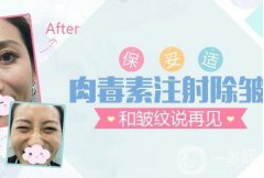 北京注射瘦臉注射去皺一般需要多少錢？