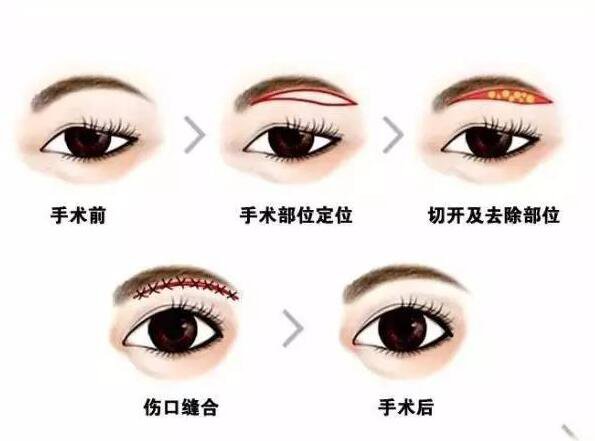 上海眉整形大概需要多少錢？