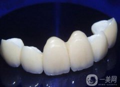 貴金屬烤瓷牙和全瓷牙信息介紹？