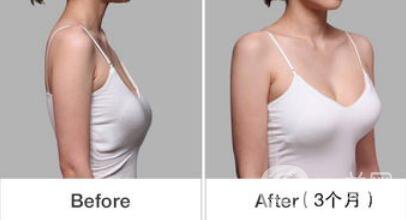 乳房下垂松軟怎么辦？可以做手術(shù)矯正嗎？