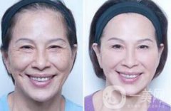 塑美極果怎么樣？塑美極要做多少次？