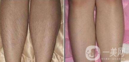 怎么去腿毛？*脫腿毛的方式是什么？