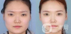 怎樣變瓜子臉？磨骨整形還是*？