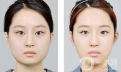 怎樣變瓜子臉？可以打*嗎？