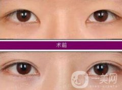 開眼角增生了能恢復(fù)嗎?開眼角會留疤嗎