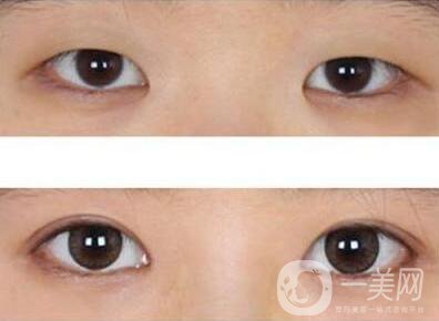 開眼角術(shù)后要眼角增生自己會消失嗎