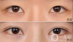 雙眼皮術(shù)后一個月能恢復(fù)自然嗎