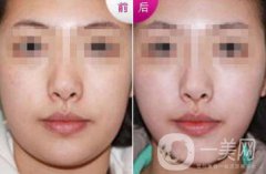 雙下巴怎么減才快速*？去雙下巴方法介紹