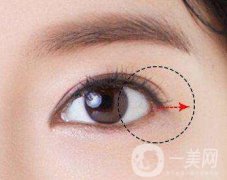 開外眼角風(fēng)險大嗎？