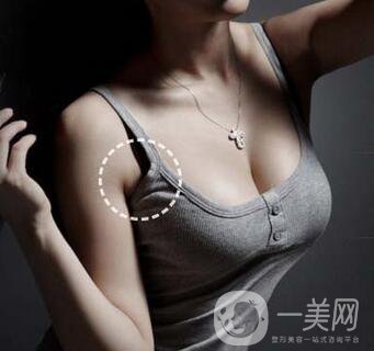 副乳切除術(shù)創(chuàng)口多大？