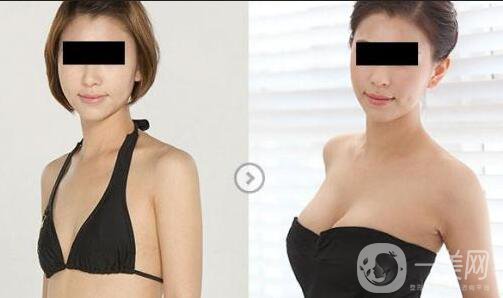 假體隆胸手術做完之后恢復期要多久時間？