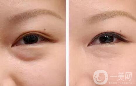超聲波去眼袋好嗎，有哪些優(yōu)點(diǎn)？