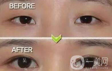 開眼角,多少錢,注意事項