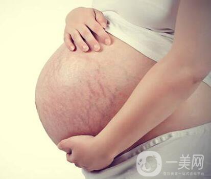 有妊娠紋怎么辦？什么方法**？