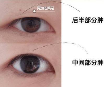眼部抽脂前后，*果*看過(guò)來(lái)！