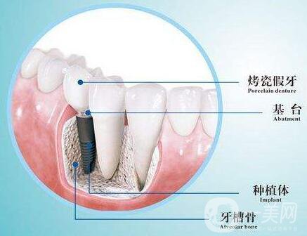 人工種植牙的價(jià)格要多少錢(qián)？