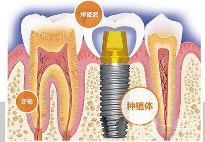 人工種植牙的價(jià)格要多少錢(qián)？