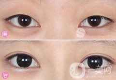 眼部手術(shù)都包含哪些項(xiàng)目？眼部手術(shù)整形多少錢