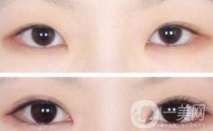 哪些人不適合做雙眼皮手術