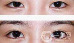 埋線雙眼皮多久消腫？幾天可以恢復自然