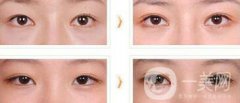 全切雙眼皮術(shù)后吃什么？術(shù)后如何護(hù)理
