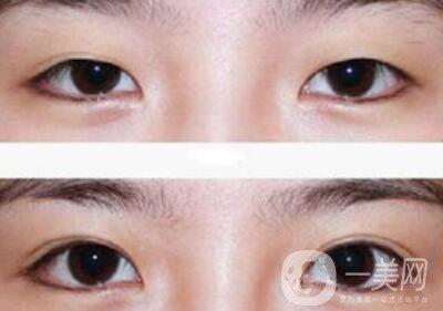 全切雙眼皮術(shù)后吃什么？術(shù)后如何護(hù)理